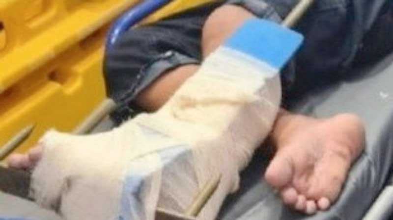 Lanca-atravessou-pe-de-menino-de-12-anos-em-Manaus