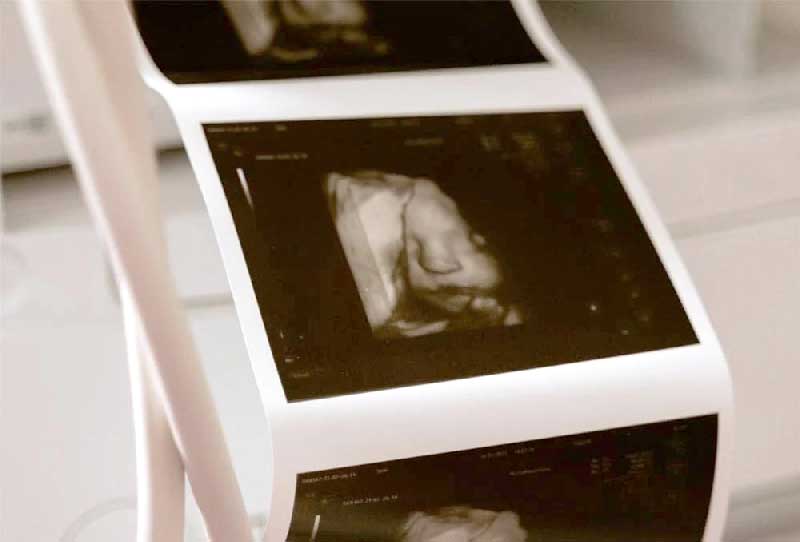 ultrassom-Tribunal-permite-aborto-de-bebê-de-35-semanas-por-ser-deficiente