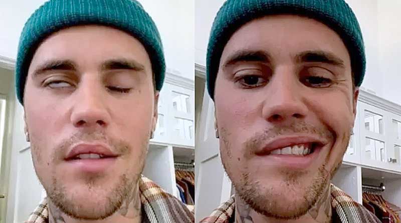 Justin-Bieber-aparece-com-rosto-paralisado-e-cancela-shows