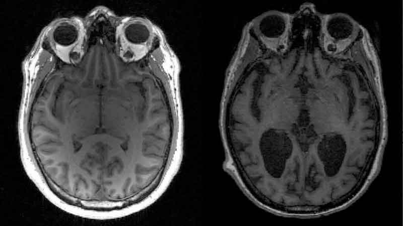 Alzheimer-Voz-Sideral