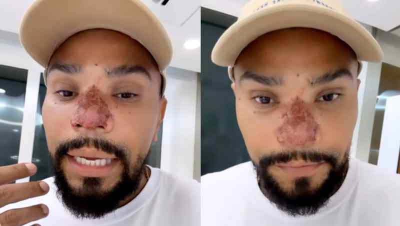 Naldo-Benny-explica-complicação-após-procedimento-estético-no-nariz