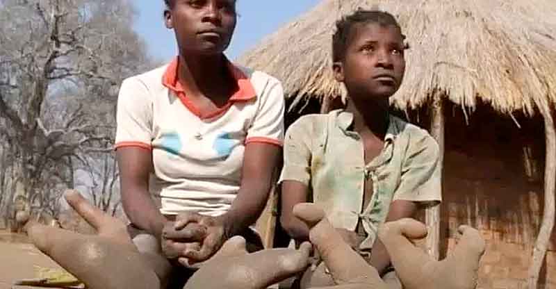 Como-vive-a-tribo-africana-que-tem-os-pés-deformados-por-mutação-genética