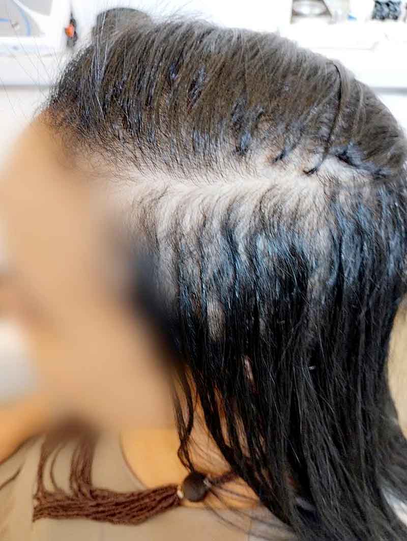 Além-da-TV-Desafios-e-soluções-para-a-perda-de-cabelo-em-mulheres