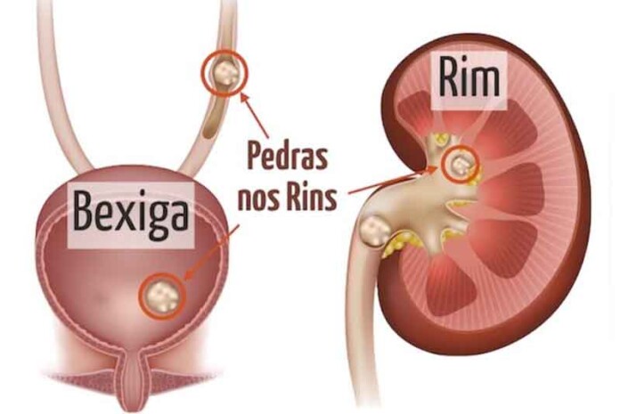 pedra-nos-rins
