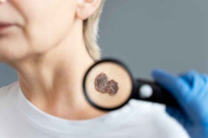 Amazonas-deve-ter-até-4,3-mil-casos-de-câncer-de-pele-até-2025-saiba-como-prevenir