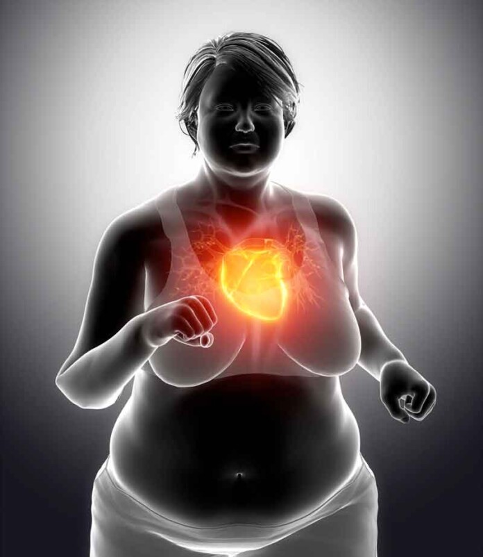Obesidade-por-mais-de-uma-década-aumenta-risco-de-infarto-e-AVC