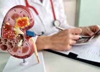 Câncer renal cresce entre mulheres e acende alerta em Manaus