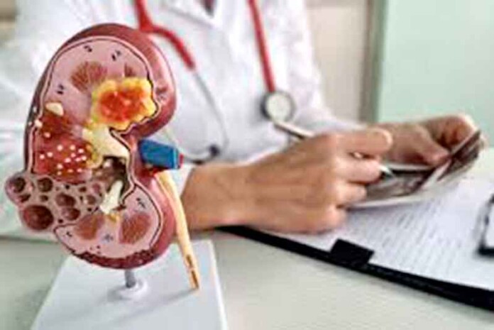 Câncer-renal-cresce-entre-mulheres-e-acende-alerta-em-Manaus