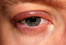 Inflamação nas pálpebras dá sinais claros e exige cuidados diários, alertam especialistas
